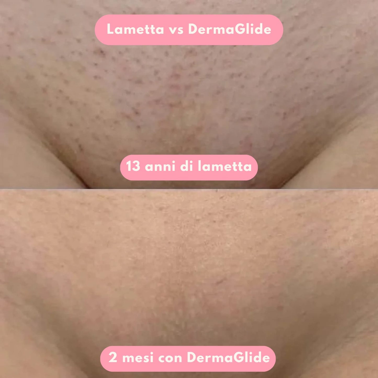 Depilatore DermaGlide™
